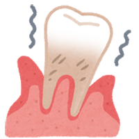 歯周病の治療イメージ画像